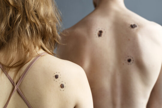 prevenzione del melanoma - come proteggere la pelle - dermatologia